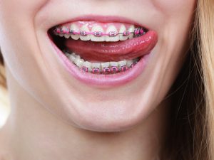 what do braces feel like center city orthodontists