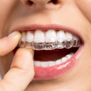 Invisalign for Adults