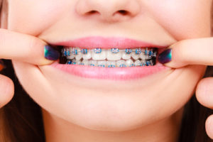 get braces now center city orthodontist