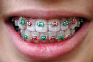 braces invisalign holidays center city orthodontist